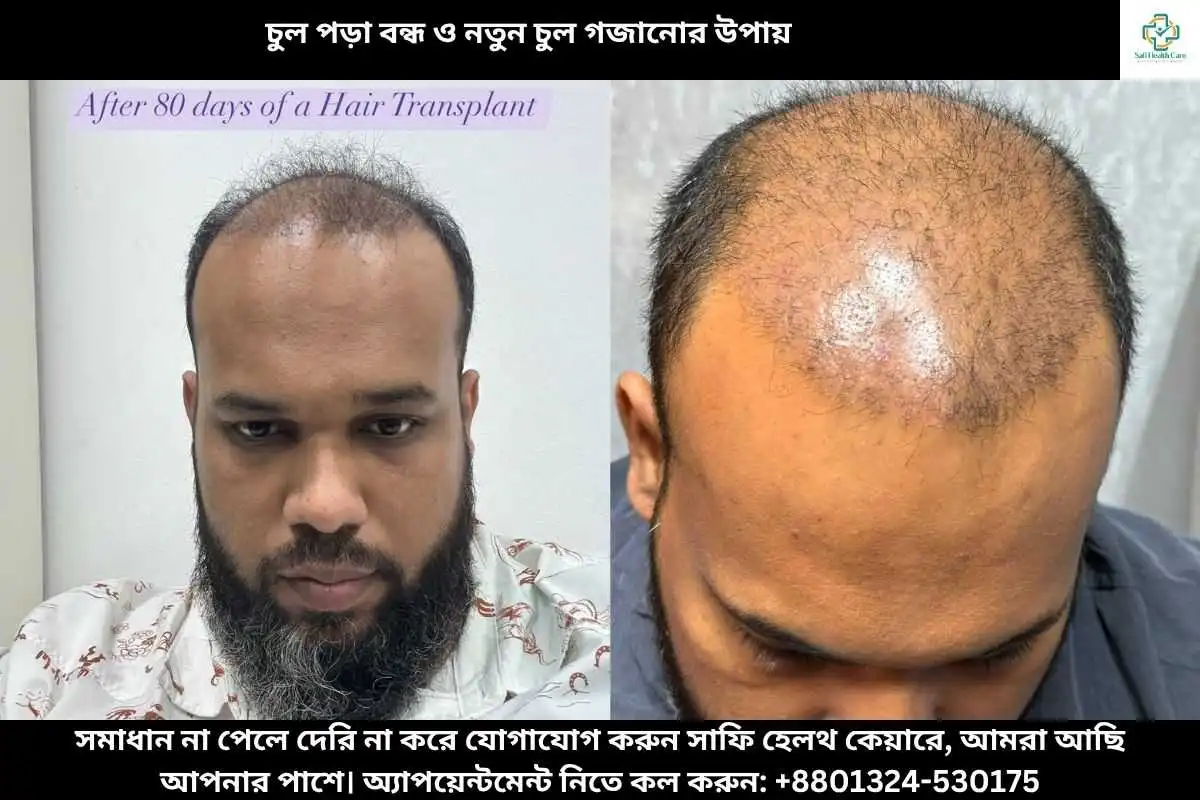 চুল পড়া বন্ধ ও নতুন চুল গজানোর উপায়