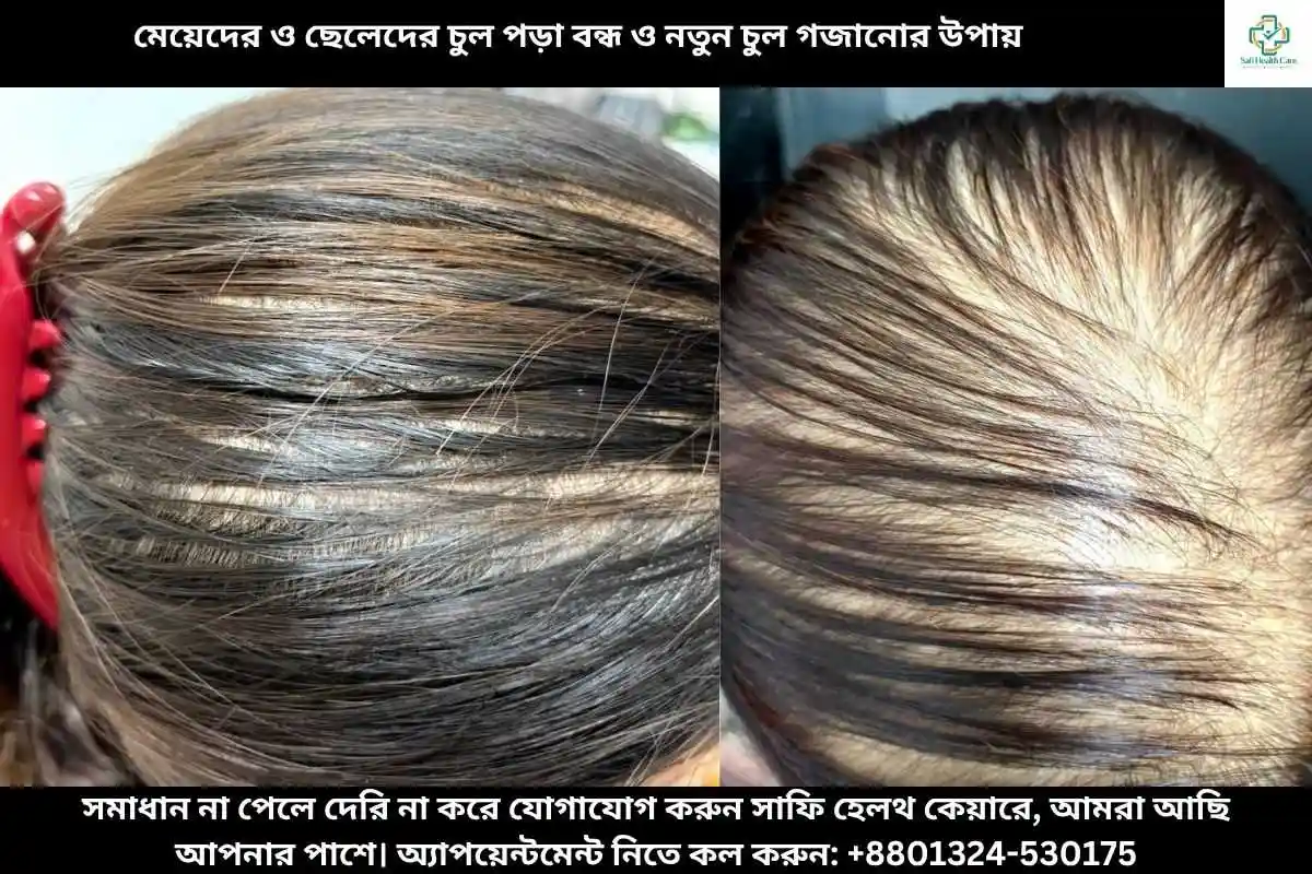 মেয়েদের ও ছেলেদের চুল পড়া বন্ধ ও নতুন চুল গজানোর উপায়