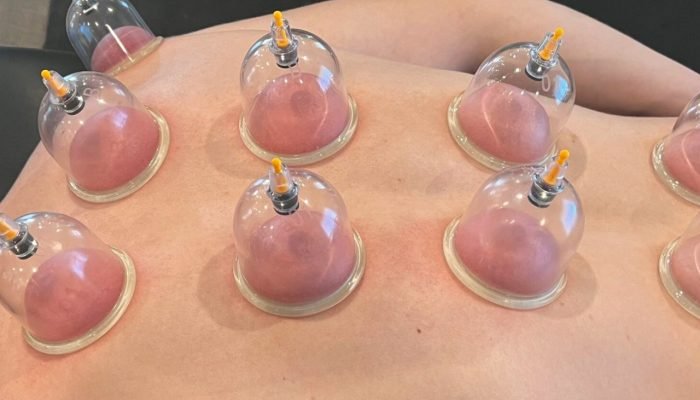 cupping